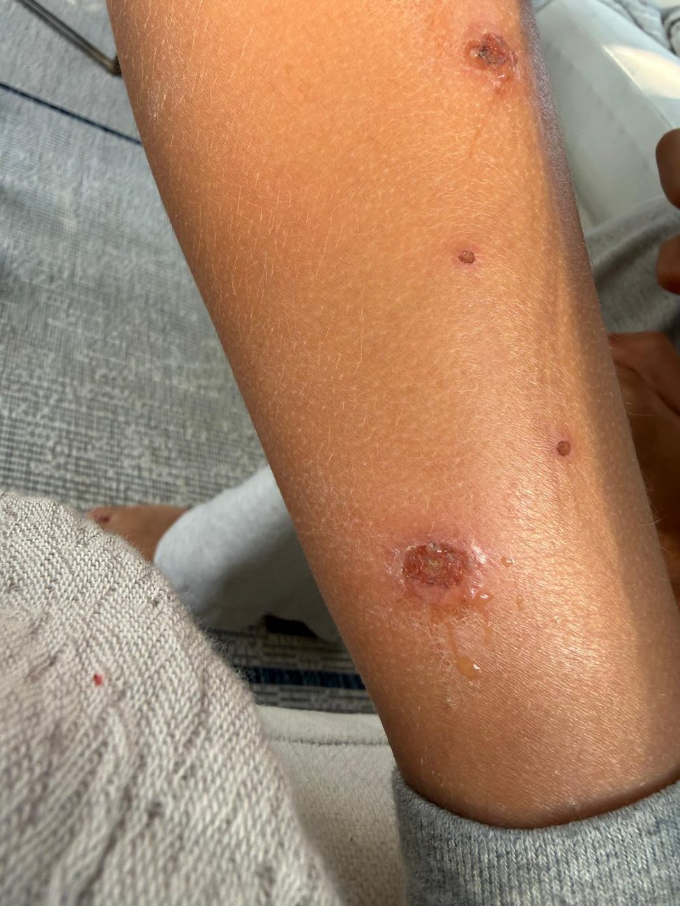 A child's lower leg with several raised, scarring bite lesions, one open and weeping