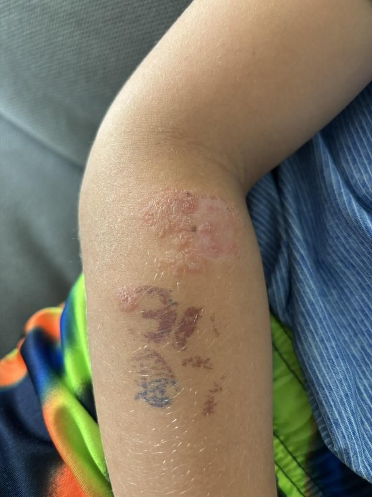 A child's arm with a large healing lesion and further marked bite sites